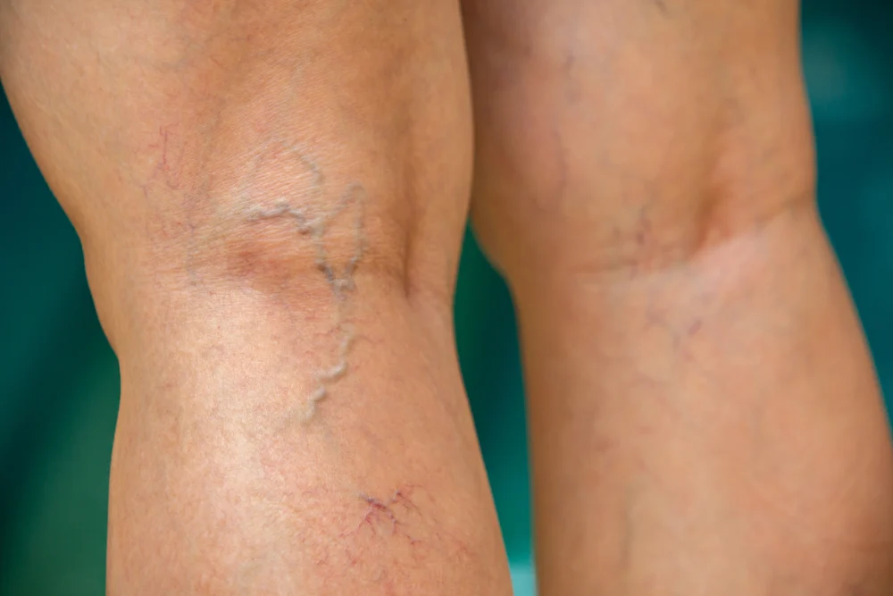 why do i have blue veins.jpg