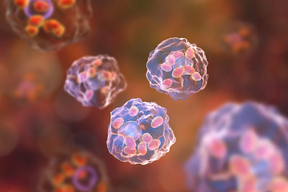 what is hemosiderosis macrophage absorbing cells.jpg