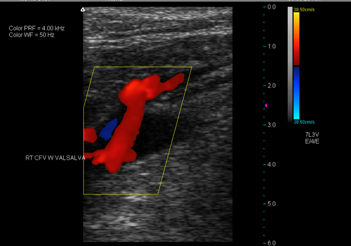 vein reflux leaky valve syndrome red