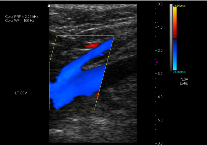 vein reflux ultrasound healthy blue