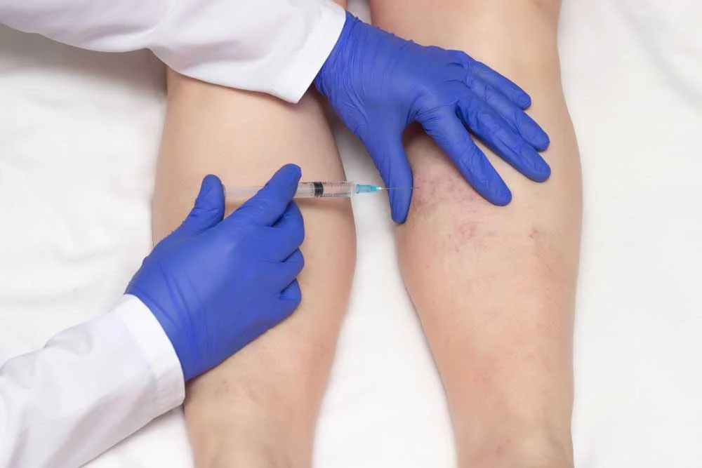 sclerotherapy what is it and how it works.jpg