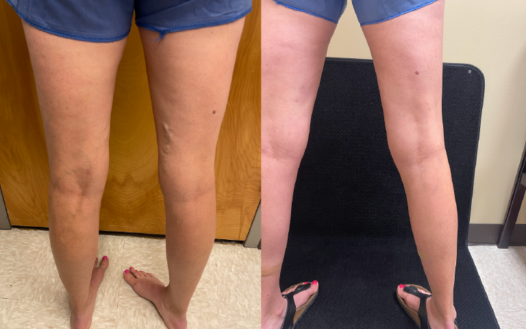mo vein before and after3