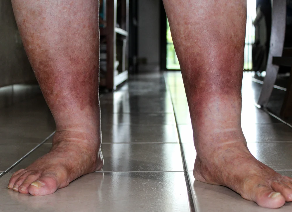 missouri vein care brown splotches on legs.jpg