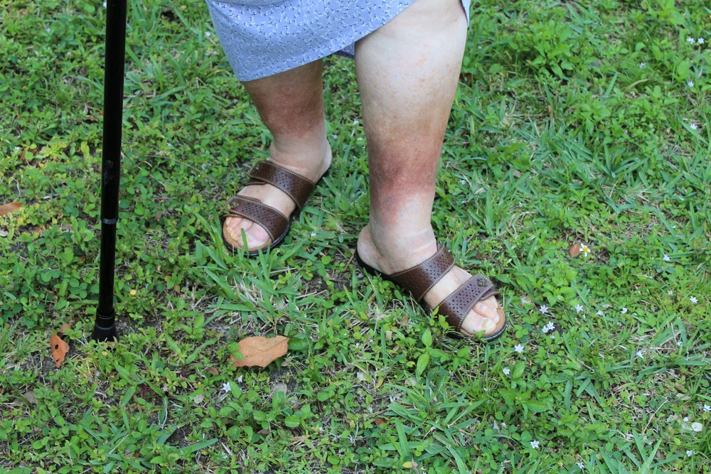 mo vein care skin discoloration.jpg