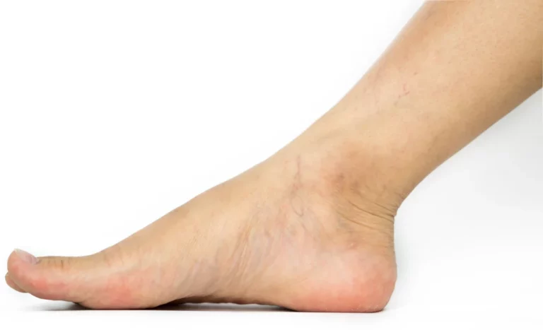 spider veins around my ankles.jpg