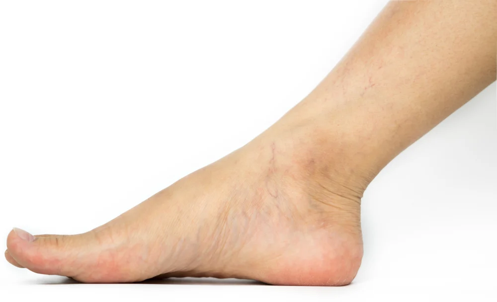 spider veins around my ankles.jpg