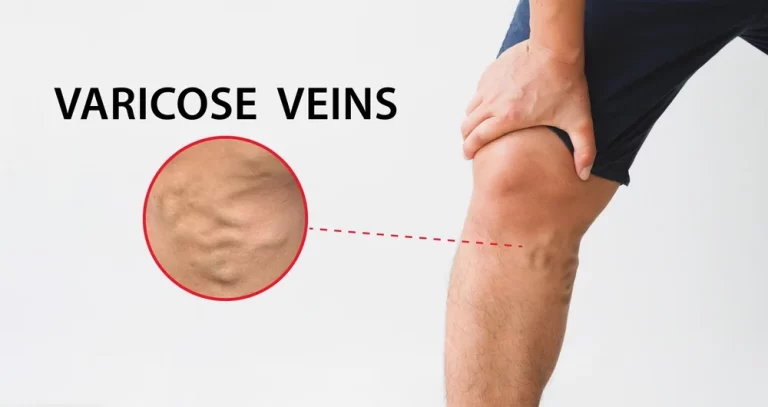 mvc varicose veins.jpg
