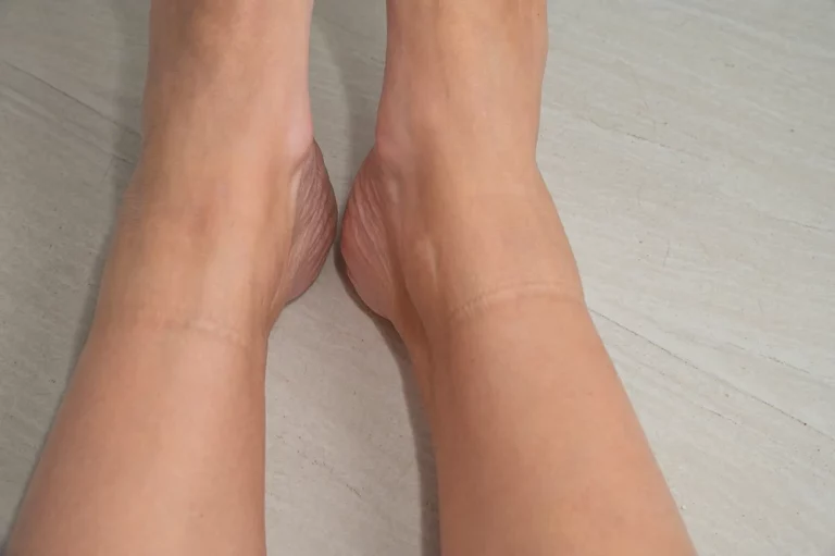 sock lines on ankles missouri vein care.jpg