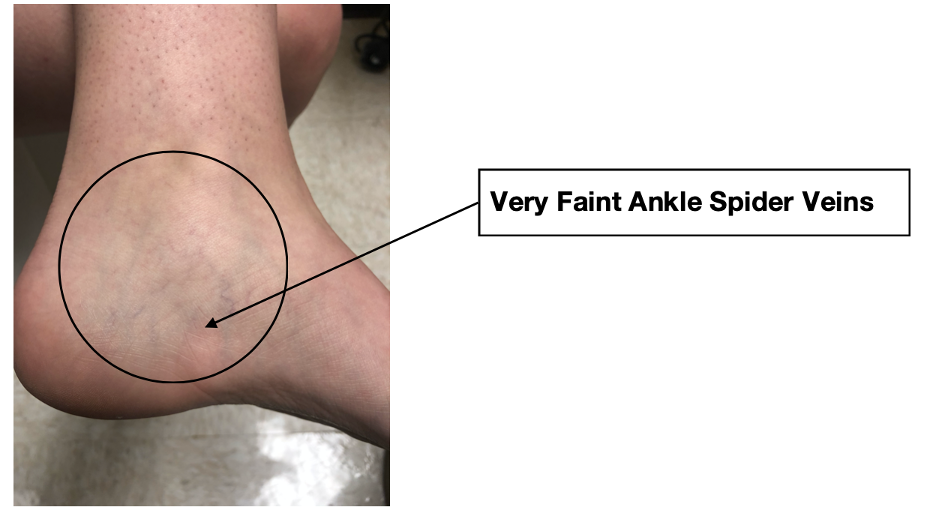 the most common appearance ankle spider veins on the foot and calf Missouri Vein Care
