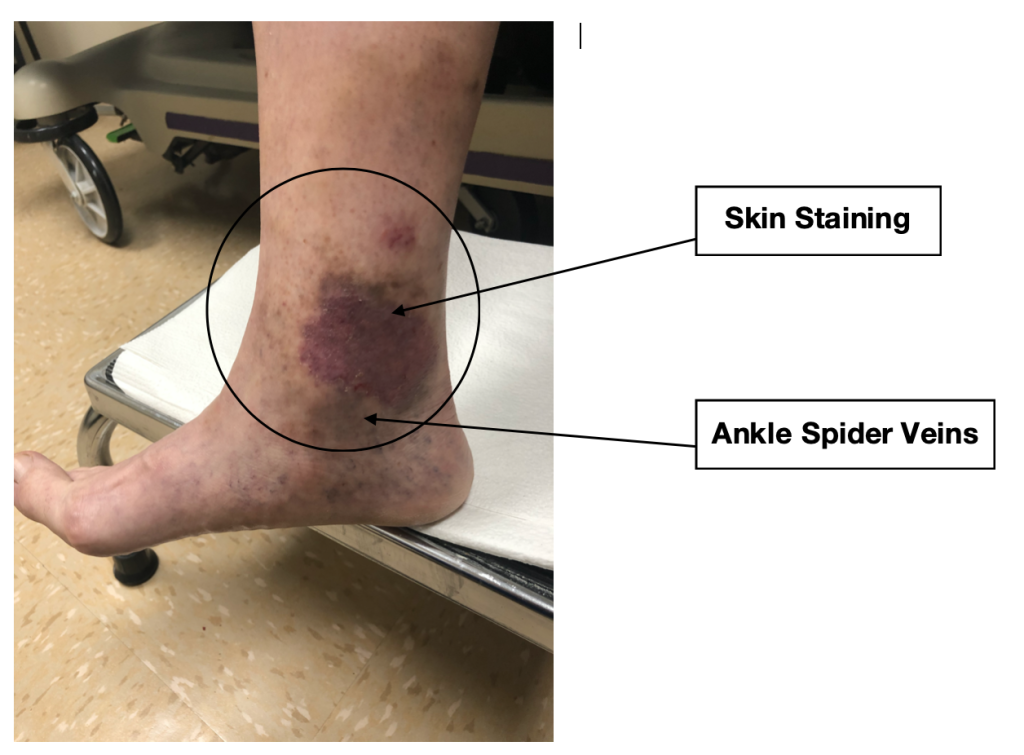 skin staining and ankle spider veins as a sign of vein reflux