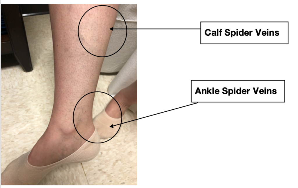 ankel and calf spider veins are a symptom of vein reflux - Missouri Vein Care