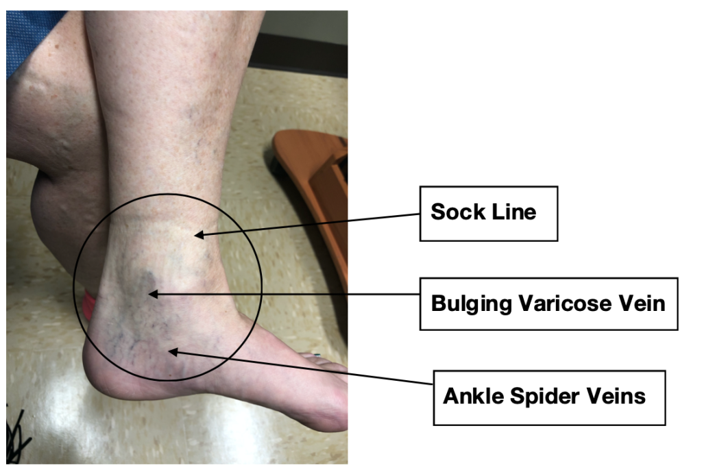 Signs of a vein condition will include sock line, ankle spider veins, and or bulging varicose veins. Missouri Vein Care