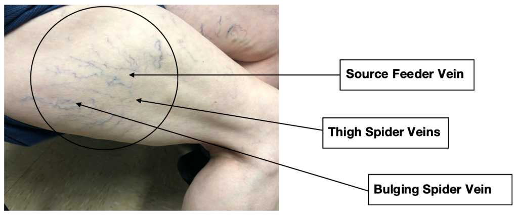 #4 thigh spider veins bulging spider veins