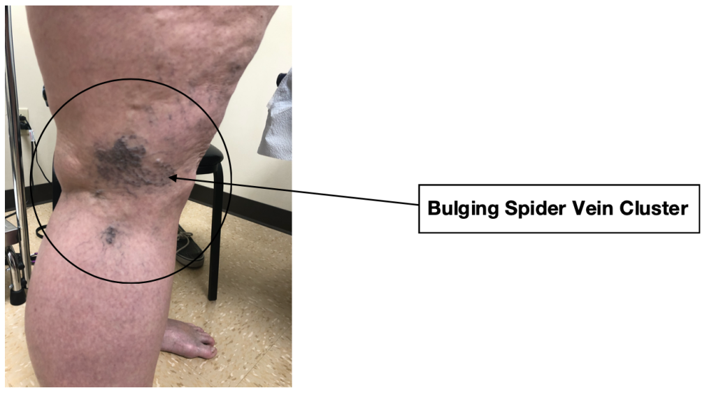 A cluster of bulging spider veins is also a sign of a vein condition