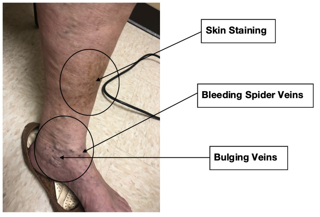 skin stains and bulgins spider veins around the ankles.