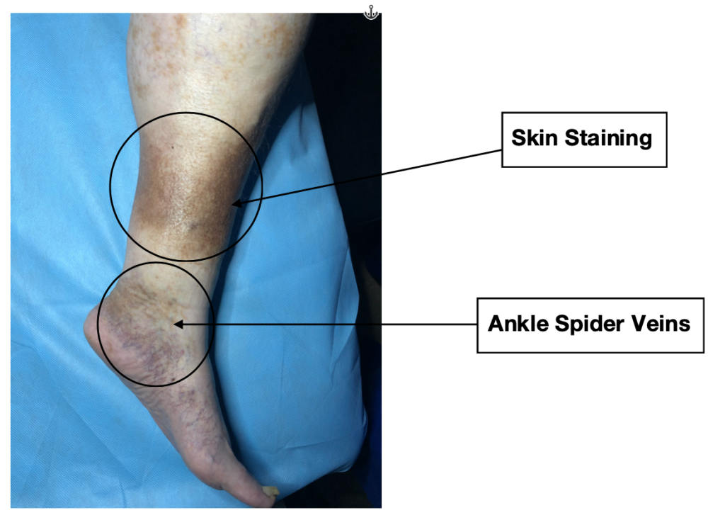 The presence of ankle spider veins and skin staining on the lower leg