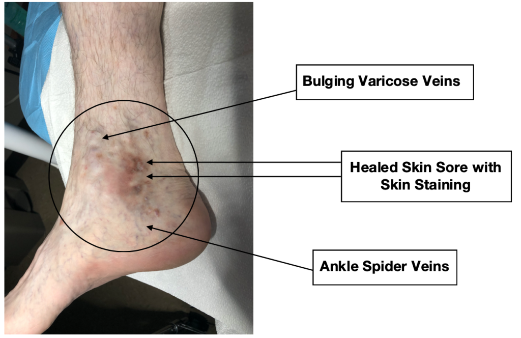 ankle spider veins and a healed skin sore with skin staining bulging varicose veins