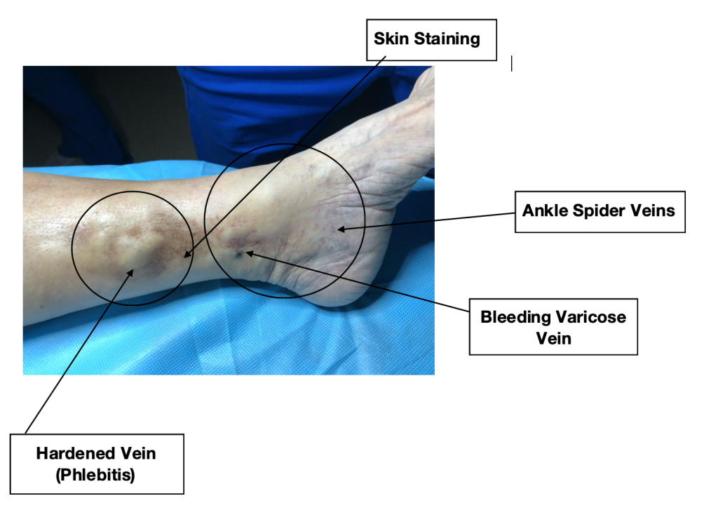 hardened veins due to phlebitis
